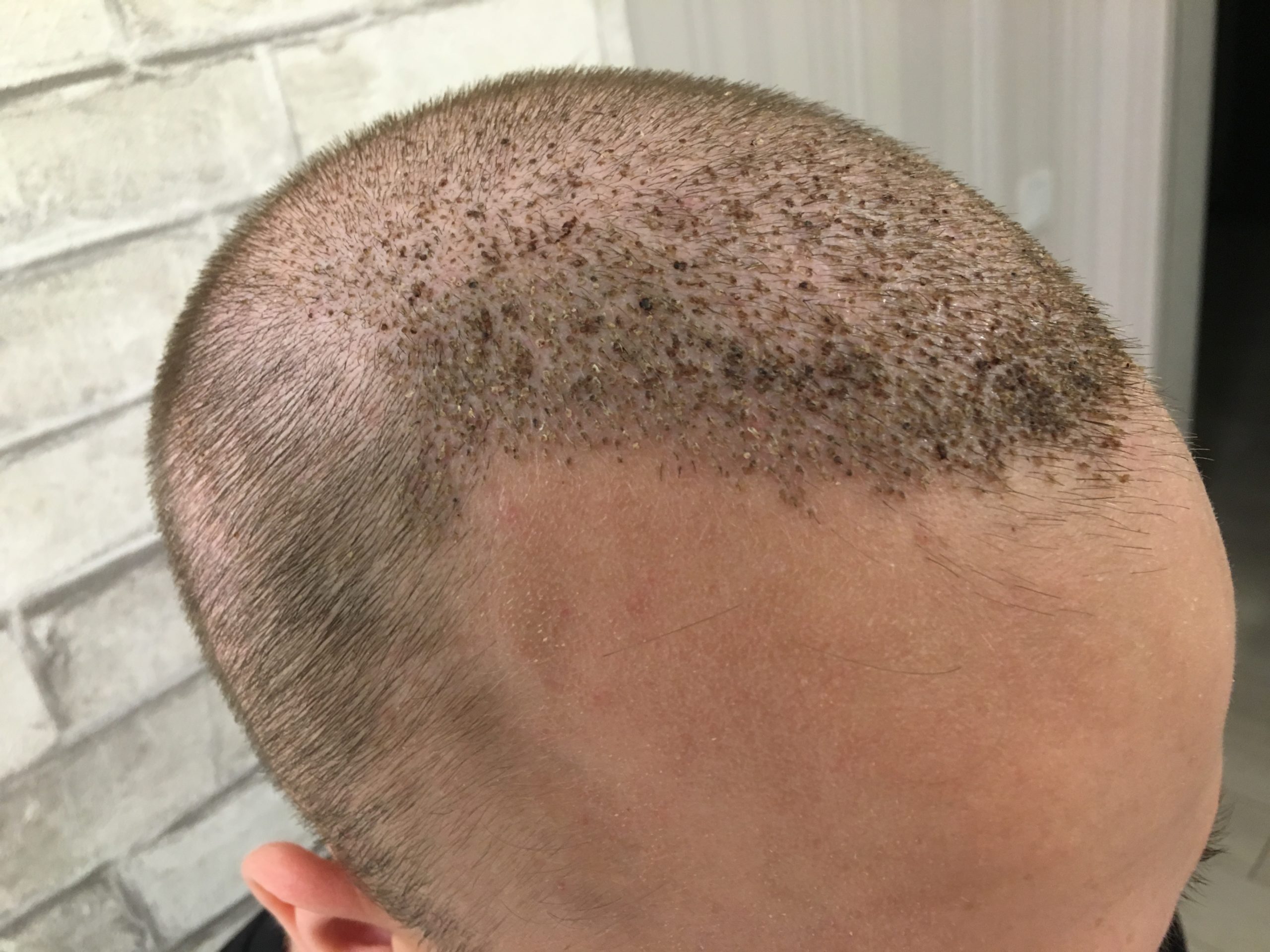 Пересадка волос в санкт петербурге