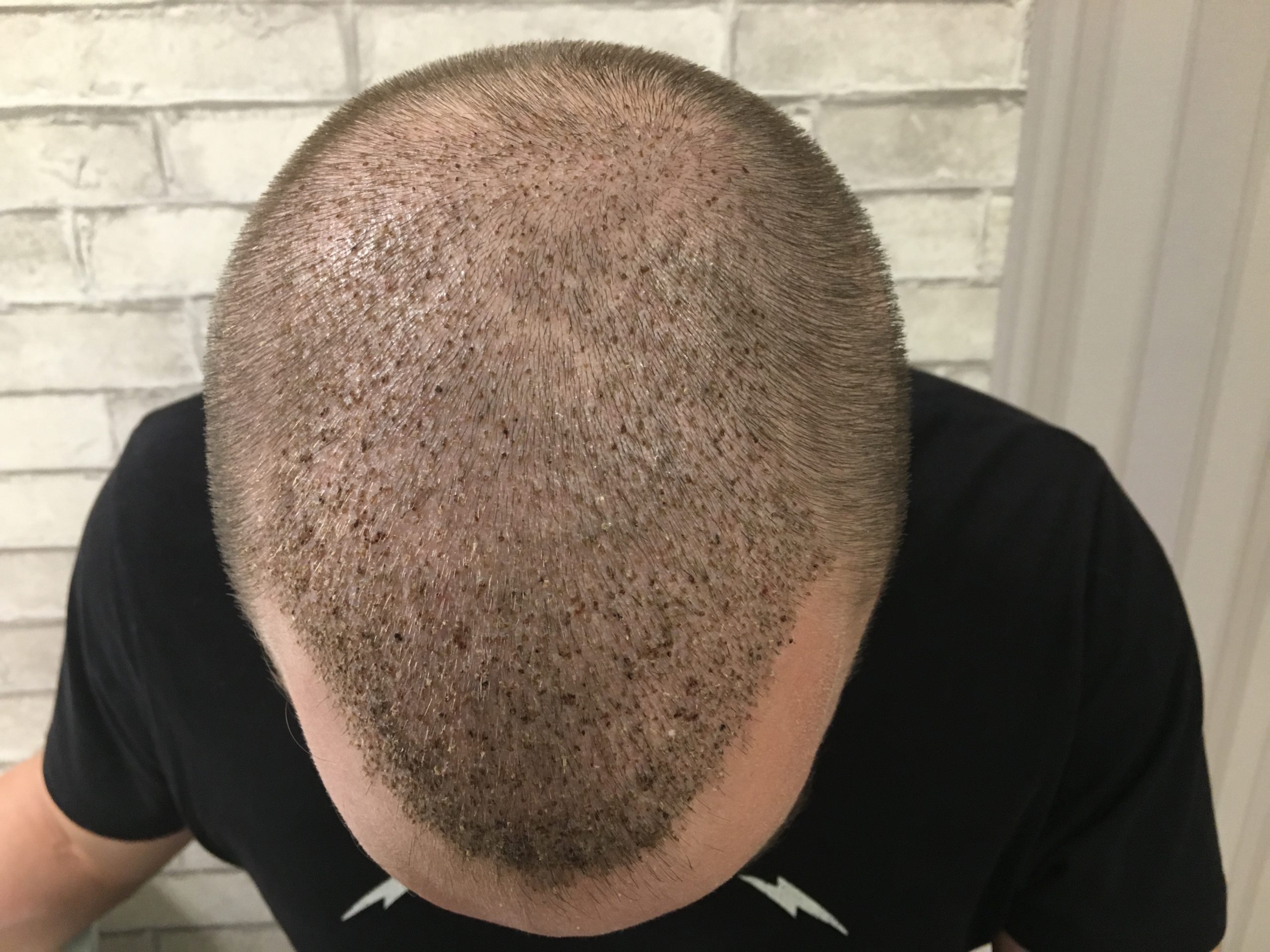 Пересадка волос красноярск. Трансплантация волос на голове. Голова после пересадки волос.