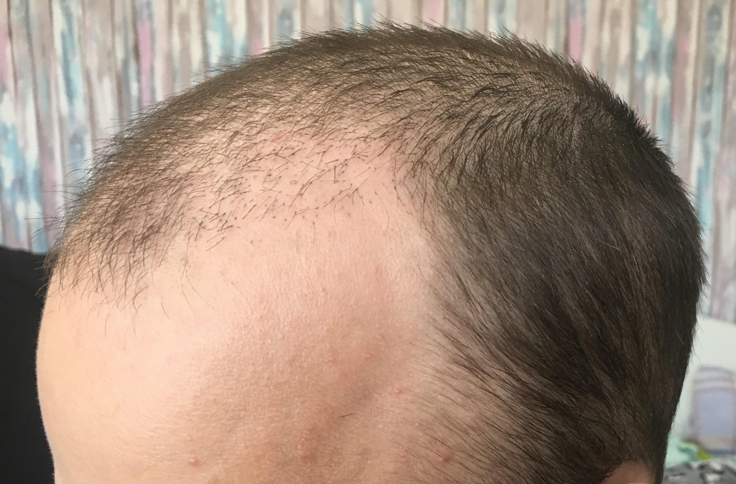 Турецкая пересадка волос. Шоковое выпадение волос после пересадки.